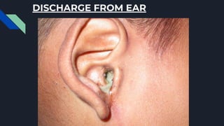 DISCHARGE FROM EAR
 
