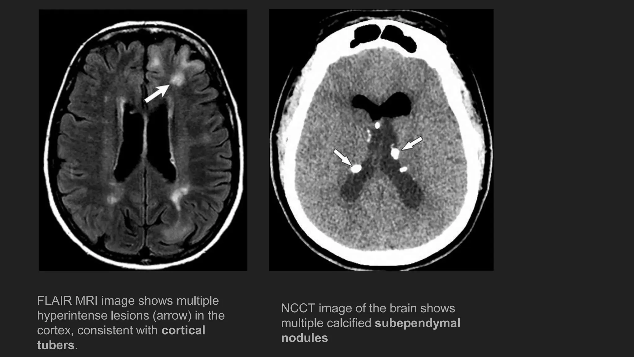 case presentation of tuberous sclerosis in a 30 year old woman | PPTX