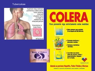 Tuberculose 