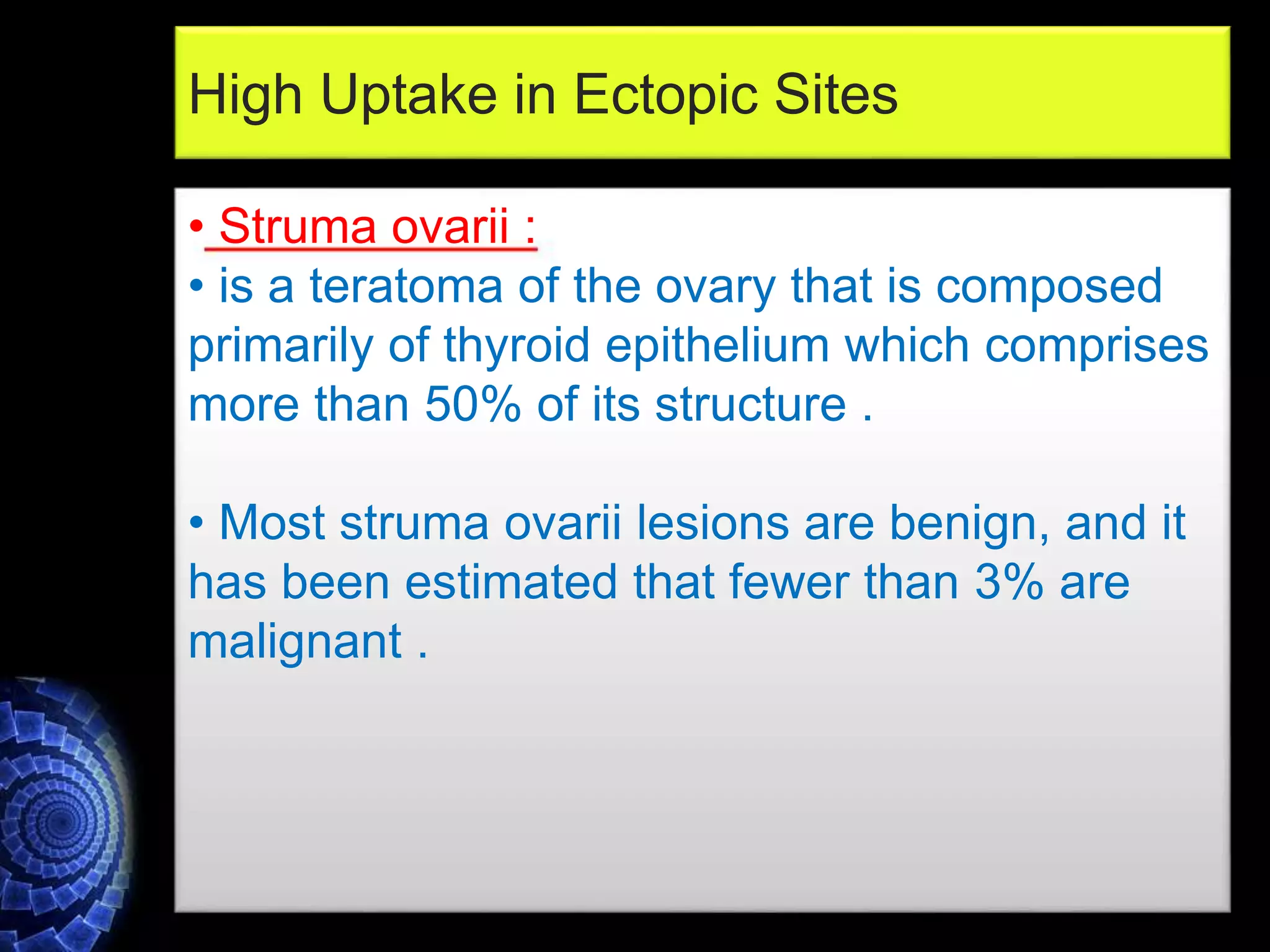 • Struma ovarii :
• is a teratoma of the ovary that is composed
primarily of thyroid epithelium which comprises
more than 50% of its structure .
• Most struma ovarii lesions are benign, and it
has been estimated that fewer than 3% are
malignant .
High Uptake in Ectopic Sites
 