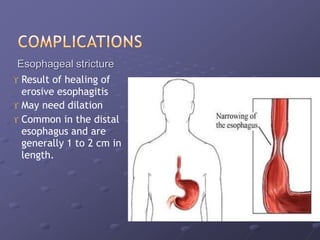  Esophageal stricture
 Result of healing of
erosive esophagitis
 May need dilation
 Common in the distal
esophagus and are
generally 1 to 2 cm in
length.
 