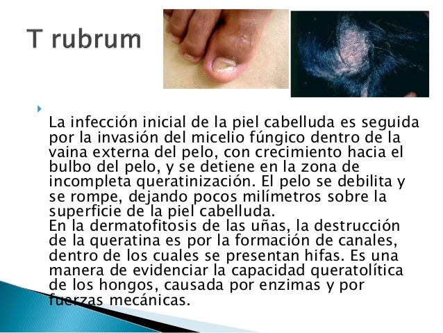 El tratamiento de la uña después de la desaparición del disco de uña que se ha exfoliado