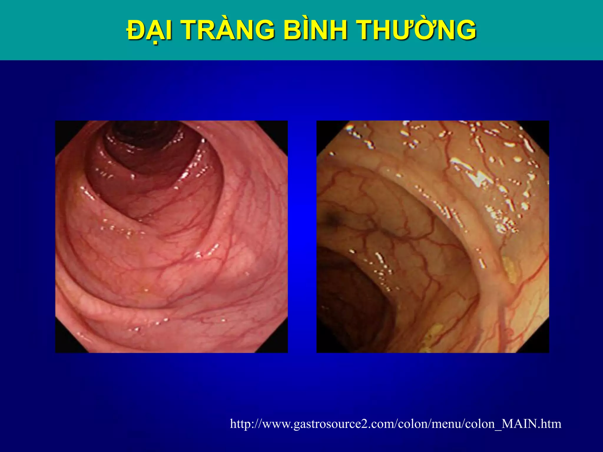 http://www.gastrosource2.com/colon/menu/colon_MAIN.htm
ĐẠI TRÀNG BÌNH THƯỜNG
 