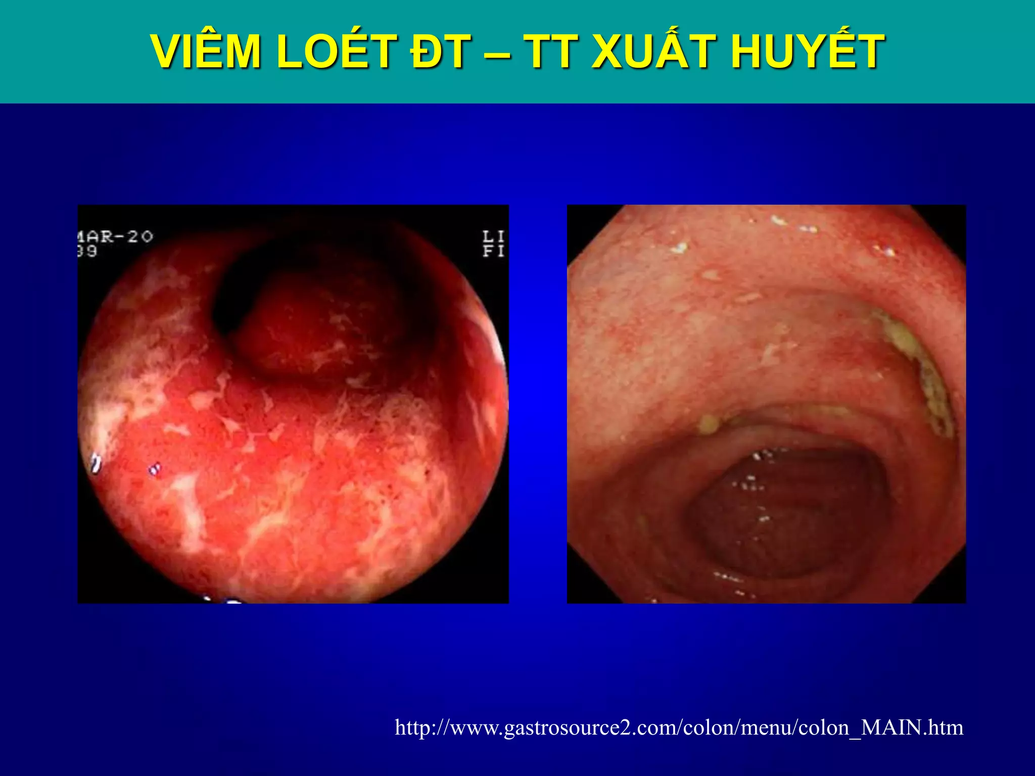 http://www.gastrosource2.com/colon/menu/colon_MAIN.htm
VIÊM LOÉT ĐT – TT XUẤT HUYẾT
 