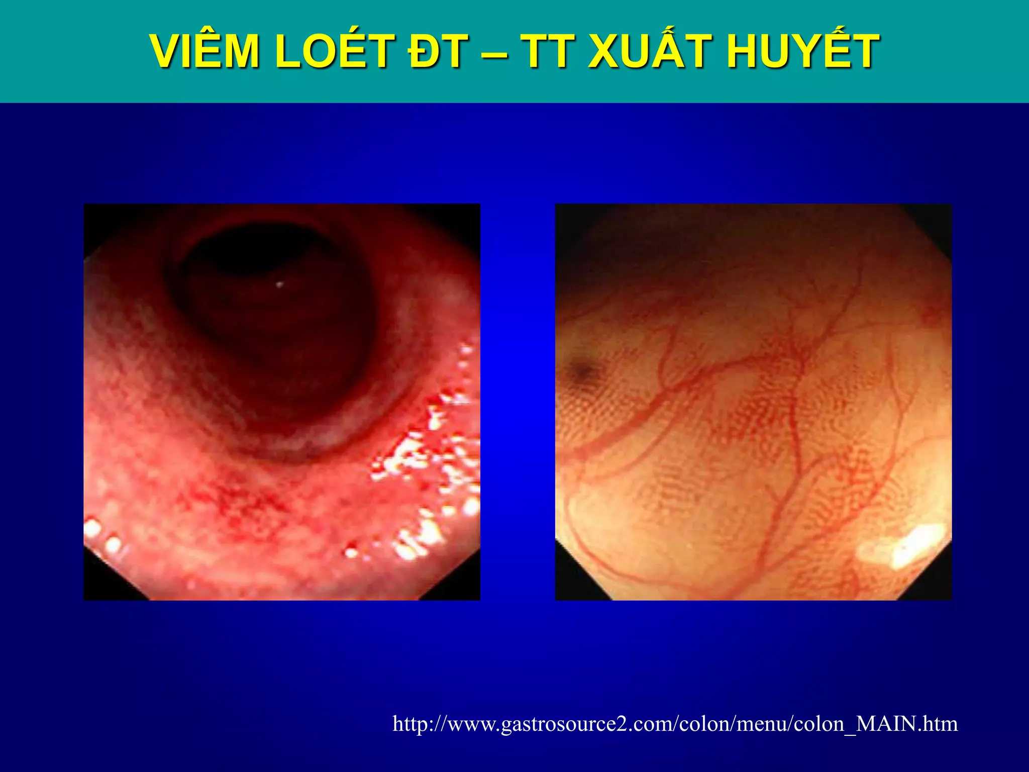 http://www.gastrosource2.com/colon/menu/colon_MAIN.htm
VIÊM LOÉT ĐT – TT XUẤT HUYẾT
 