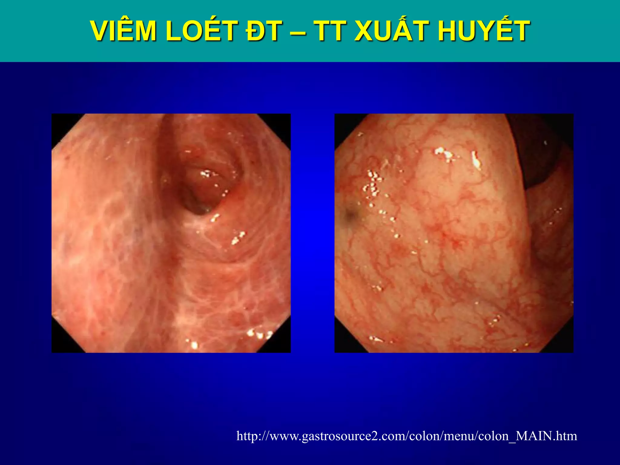 http://www.gastrosource2.com/colon/menu/colon_MAIN.htm
VIÊM LOÉT ĐT – TT XUẤT HUYẾT
 
