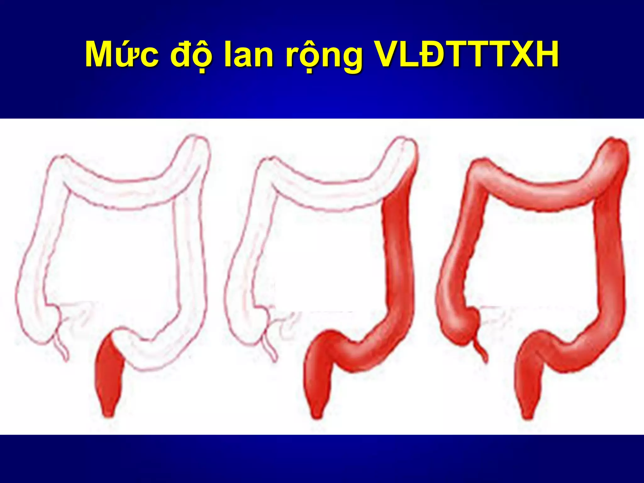 Mức độ lan rộng VLĐTTTXH
 
