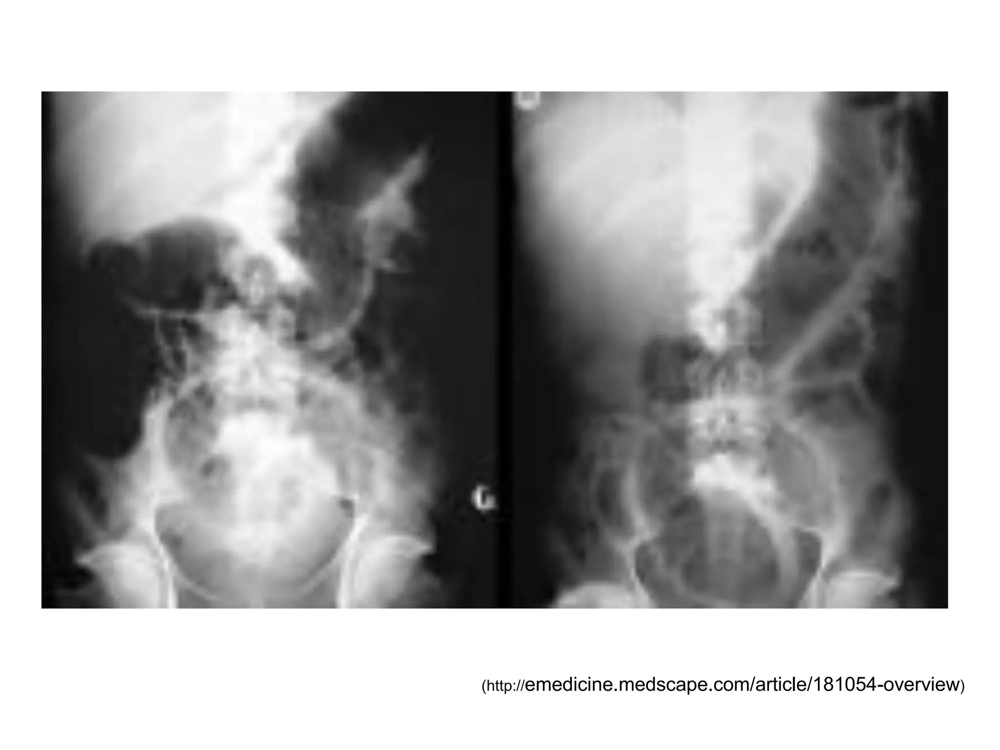 (http://emedicine.medscape.com/article/181054-overview)
 