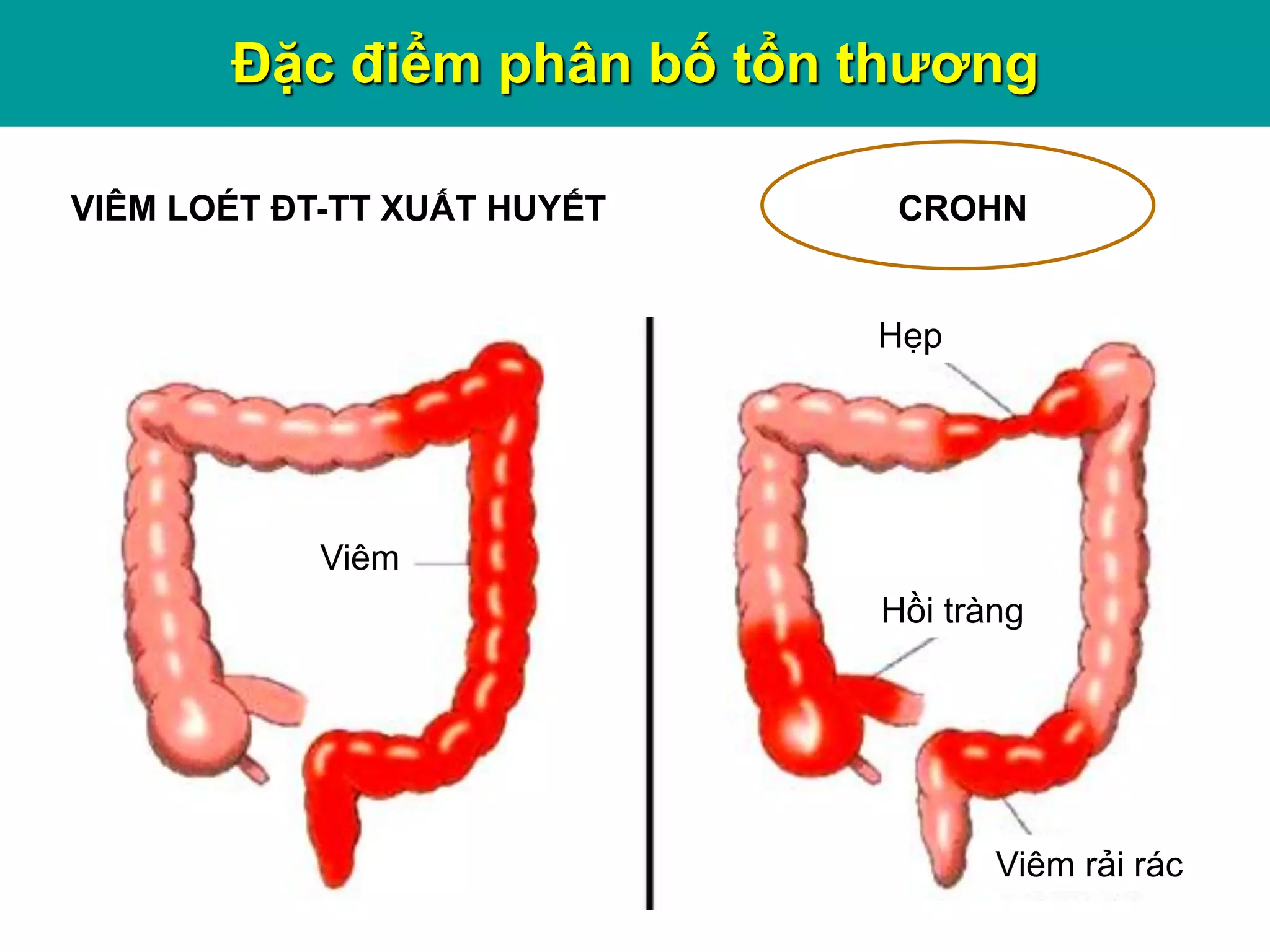 Hẹp
Viêm
Hồi tràng
Viêm rải rác
VIÊM LOÉT ĐT-TT XUẤT HUYẾT CROHN
Đặc điểm phân bố tổn thương
 