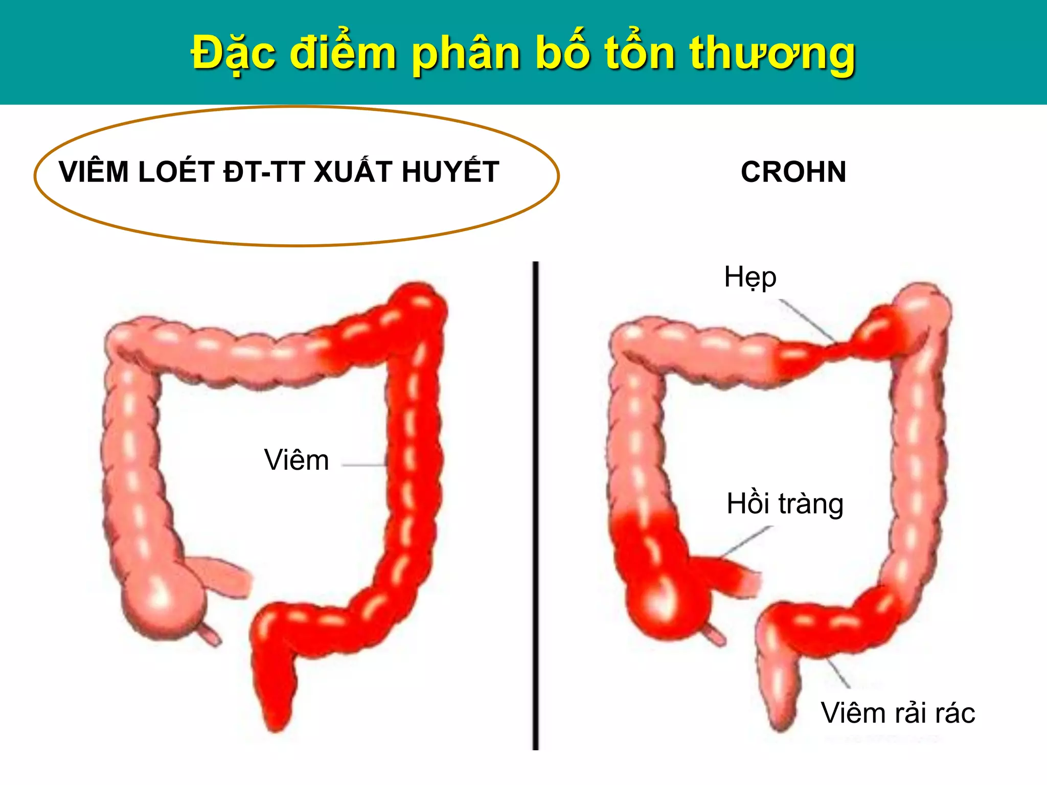 Hẹp
Viêm
Hồi tràng
Viêm rải rác
VIÊM LOÉT ĐT-TT XUẤT HUYẾT CROHN
Đặc điểm phân bố tổn thương
 