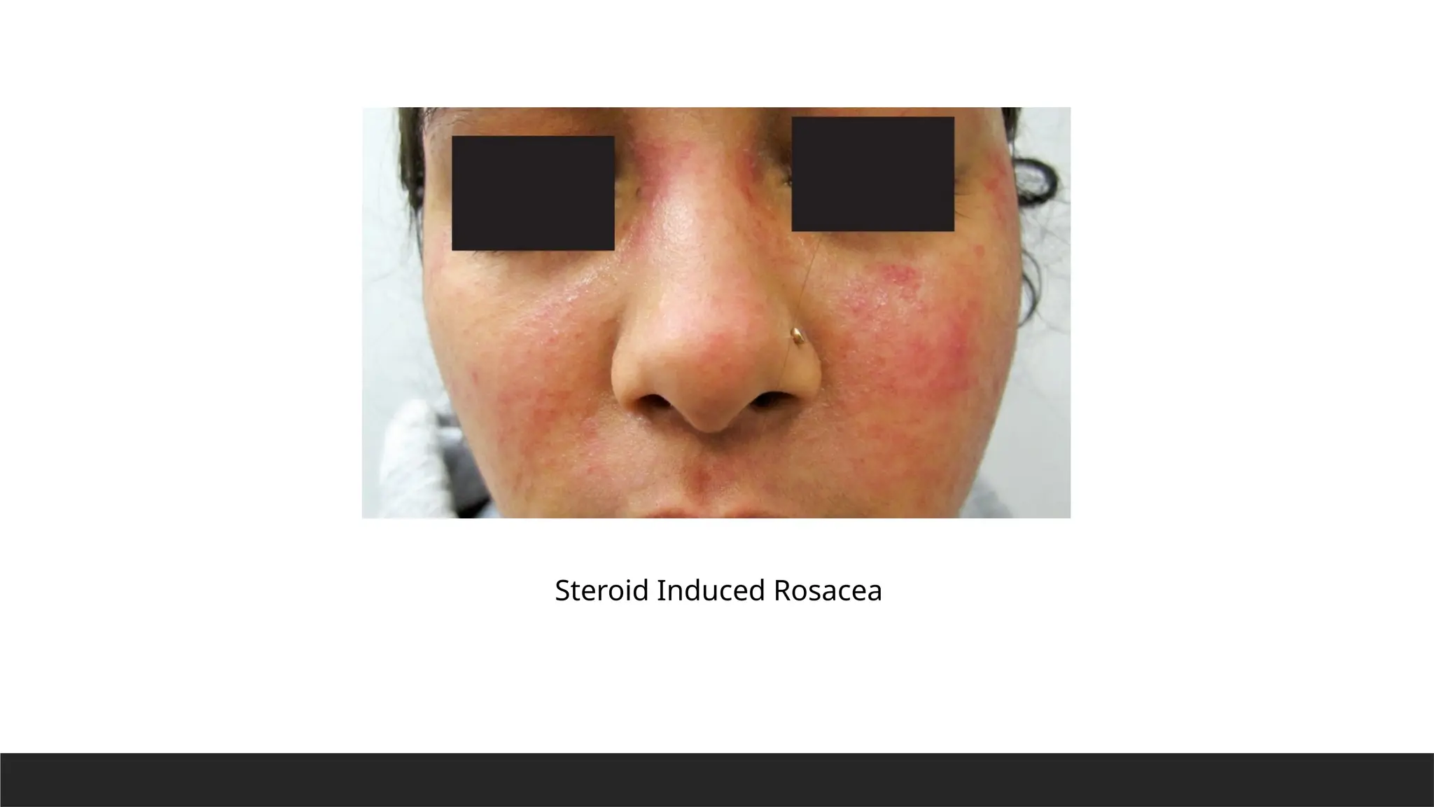 Acne Rosacea Presentation and its treatment | PPTX