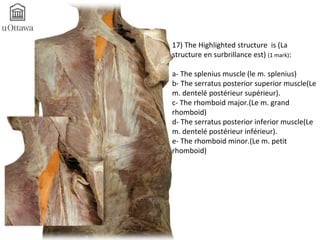 17) The Highlighted structure is (La 
structure en surbrillance est) (1 mark): 
a- The splenius muscle (le m. splenius) 
b- The serratus posterior superior muscle(Le 
m. dentelé postérieur supérieur). 
c- The rhomboid major.(Le m. grand 
rhomboid) 
d- The serratus posterior inferior muscle(Le 
m. dentelé postérieur inférieur). 
e- The rhomboid minor.(Le m. petit 
rhomboid) 
 