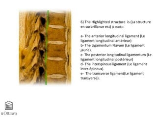 6) The Highlighted structure is (La structure 
en surbrillance est) (1 mark): 
a- The anterior longitudinal ligament (Le 
ligament longitudinal antérieur) 
b- The Ligamentum Flavum (Le ligament 
jaune). 
c- The posterior longitudinal ligamentum (Le 
ligament longitudinal postérieur) 
d- The interspinous ligament (Le ligament 
inter-épineux). 
e- The transverse ligament(Le ligament 
transverse). 
 
