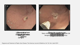 Úlcera de la base
limpia del antro
gástrico
Úlcera de curvatura con
coagulo adherente
Úlcera de curvatura Úlcera gástrica con
coagulo adherente
Vaso visible
que no
sangra
Vaso visible que no sangra después de
terapia de coagulación térmica
Diagnosis and Treatment of Peptic Ulcer Disease. The American Journal of Medicine, Vol 132, No 4, April 2019
 