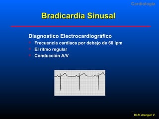 Cardiologia

Bradicardia Sinusal
Diagnostico Electrocardiográfico




Frecuencia cardiaca por debajo de 60 lpm
El ritmo regular
Conducción A/V

Dr.R. Arangurí V.

 
