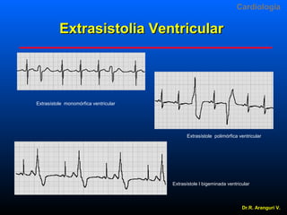 Cardiologia

Extrasistolia Ventricular

Extrasístole monomórfica ventricular

Extrasístole polimórfica ventricular

Extrasístole l bigeminada ventricular

Dr.R. Arangurí V.

 