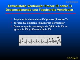 Cardiologia

Extrasistolia Ventricular Precoz (R sobre T)
Desencadenando una Taquicardia Ventricular




Taquicardia sinusal con EV precoz (R sobre T)
Tercera EV empieza Taquicardia Ventricular
Observe que la morfología de QRS de la EV es
igual a la TV y diferente de la FV.

Dr.R. Arangurí V.

 