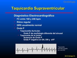 Cardiologia

Taquicardia Supraventricular
Diagnóstico Electrocardiográfico


 




FC entre 160 y 240 bpm
Ritmo regular
QRS usualmente normal
Onda P




Taquicardia Auricular.
 Onda P de morfología diferente del sinusal
Taquicarda de la Unión
 Ausencia de Onda P
 Onda P negativa en DII, DIII y aVF

Taquicardia 
auricular iniciada 
por una ESV 

Dr.R. Arangurí V.

 