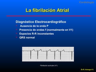 Cardiologia

La fibrilación Atrial
Diagnóstico Electrocardiográfico





Ausencia de la onda P
Presencia de ondas f (normalmente en V1)
Espacios R-R inconstantes
QRS normal

Fibrilación auricular (V1) 
Dr.R. Arangurí V.

 