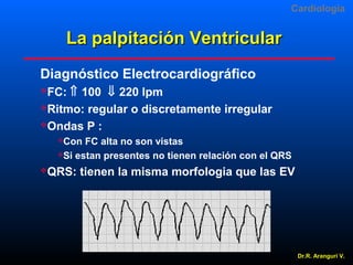 Cardiologia

La palpitación Ventricular
Diagnóstico Electrocardiográfico
⇑ 100 ⇓ 220 lpm
Ritmo: regular o discretamente irregular
Ondas P :
FC:
 

Con FC alta no son vistas
Si estan presentes no tienen relación con el QRS


QRS:

tienen la misma morfologia que las EV

Dr.R. Arangurí V.

 