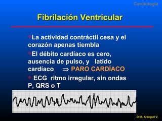 Cardiologia

Fibrilación Ventricular
La

actividad contráctil cesa y el
corazón apenas tiembla
El débito cardíaco es cero,
ausencia de pulso, y latido
cardíaco ⇒ PARO CARDÍACO
 ECG ritmo irregular, sin ondas
P, QRS o T

Dr.R. Arangurí V.

 