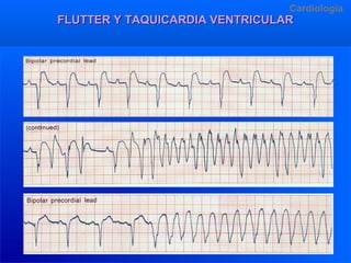 Cardiologia

FLUTTER Y TAQUICARDIA VENTRICULAR

Dr.R. Arangurí V.

 