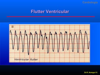 Cardiologia

Flutter Ventricular

Dr.R. Arangurí V.

 
