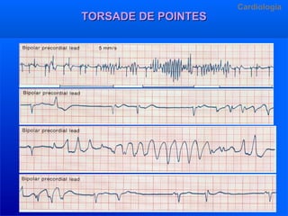 TORSADE DE POINTES

Cardiologia

Dr.R. Arangurí V.

 