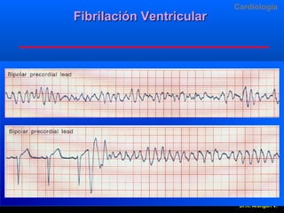 Fibrilación Ventricular

Cardiologia

Dr.R. Arangurí V.

 