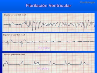 Fibrilación Ventricular

Cardiologia

No pulse

No pulse

Dr.R. Arangurí V.

 