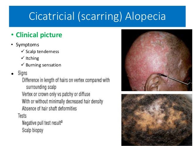 Hair Diseases