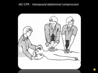 IAC-CPR :  Interposed abdominal compression  