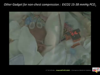 Other Gadget for non-chest compression :  EtCO2 15-38 mmHg PCO 2 