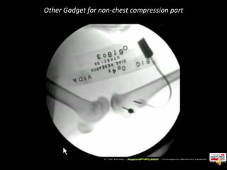 Other Gadget for non-chest compression part 