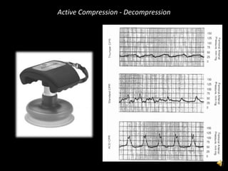 Active Compression - Decompression 