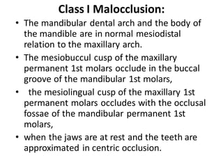 Class I Malocclusion:
• The mandibular dental arch and the body of
the mandible are in normal mesiodistal
relation to the maxillary arch.
• The mesiobuccul cusp of the maxillary
permanent 1st molars occlude in the buccal
groove of the mandibular 1st molars,
• the mesiolingual cusp of the maxillary 1st
permanent molars occludes with the occlusal
fossae of the mandibular permanent 1st
molars,
• when the jaws are at rest and the teeth are
approximated in centric occlusion.
 
