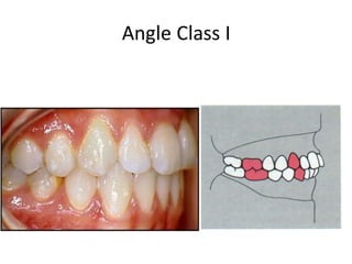 Angle Class I
 