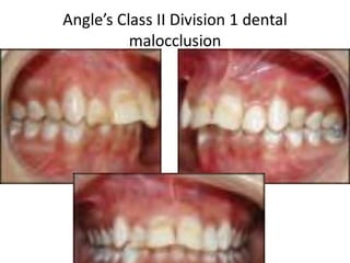 Angle’s Class II Division 1 dental
malocclusion
 