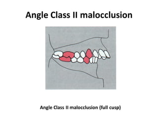 Angle Class II malocclusion
Angle Class II malocclusion (full cusp)
 