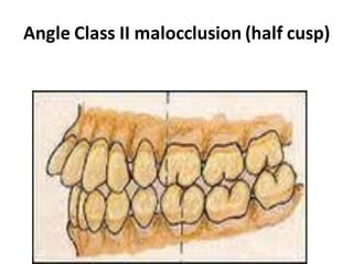 Angle Class II malocclusion (half cusp)
 