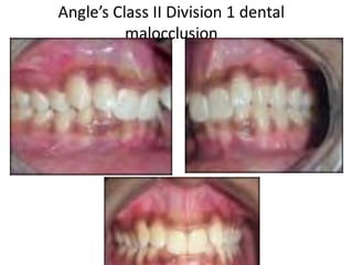 Angle’s Class II Division 1 dental
malocclusion
 