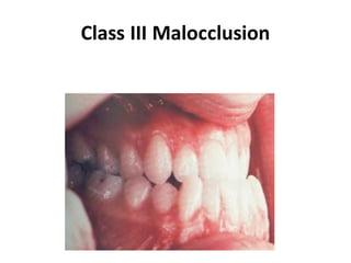 Class III Malocclusion
 
