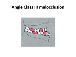 Angle Class III malocclusion
 