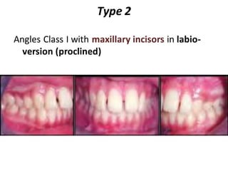 Type 2
Angles Class I with maxillary incisors in labio-
version (proclined)
 