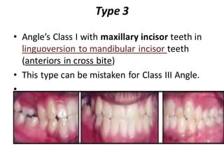 Type 3
• Angle’s Class I with maxillary incisor teeth in
linguoversion to mandibular incisor teeth
(anteriors in cross bite)
• This type can be mistaken for Class III Angle.
•
 