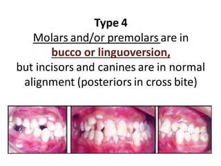Type 4
Molars and/or premolars are in
bucco or linguoversion,
but incisors and canines are in normal
alignment (posteriors in cross bite)
 