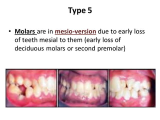 Type 5
• Molars are in mesio-version due to early loss
of teeth mesial to them (early loss of
deciduous molars or second premolar)
 