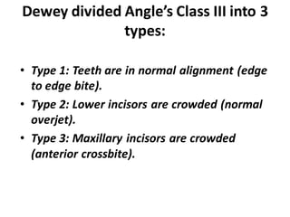 Dewey divided Angle’s Class III into 3
types:
• Type 1: Teeth are in normal alignment (edge
to edge bite).
• Type 2: Lower incisors are crowded (normal
overjet).
• Type 3: Maxillary incisors are crowded
(anterior crossbite).
 