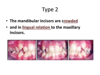 Type 2
• The mandibular incisors are crowded
• and in lingual relation to the maxillary
incisors.
 