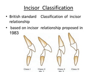 Incisor Classification
• British standard Classification of incisor
relationship
• based on incisor relationship proposed in
1983
 